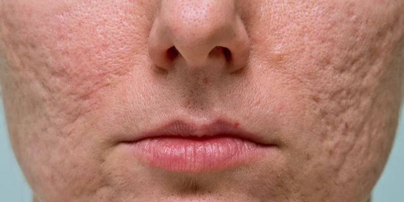 Acne scars