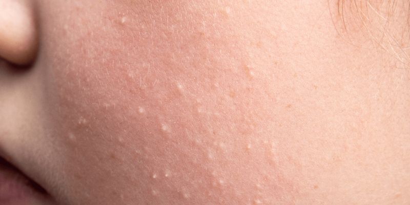 Comedonal acne