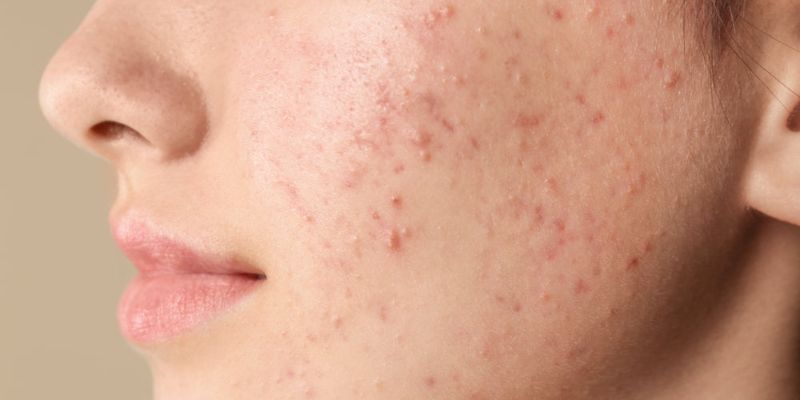 Heat triggered acne