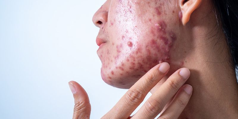 Hormonal acne