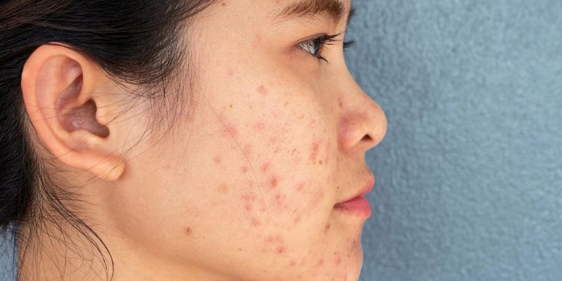 Post acne marks